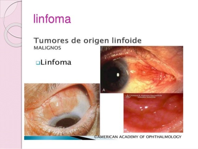linfoma orbitario